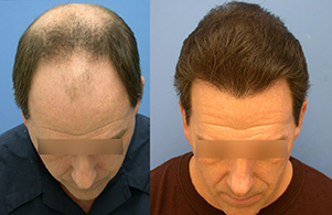 Derman Hair Transplant