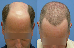 Derman Hair Transplant