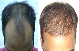 Derman Hair Transplant