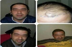 Derman Hair Transplant