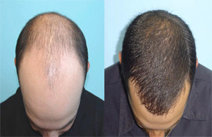 Derman Hair Transplant