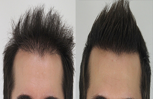 Derman Hair Transplant